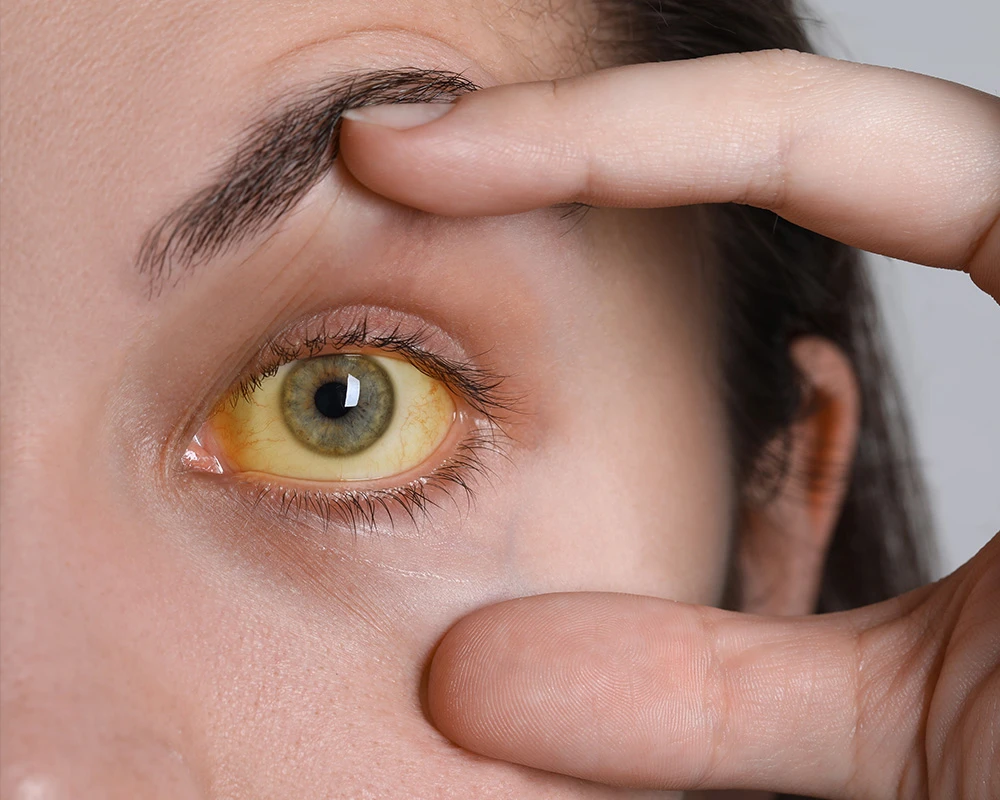 Geel oogwit door alcohol zichtbaar bij vrouw die haar oog openhoudt.